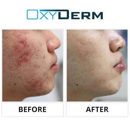 Acne Treatment Pads- Eliminates Pimple, Whitehead, blackhead, & Cystic Breakouts. Clear Clogged Pores, Oily Skin, Blemish, Dark Spots & Improve Skin Texture. 60 count