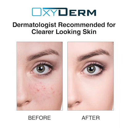 Acne Treatment Pads- Eliminates Pimple, Whitehead, blackhead, & Cystic Breakouts. Clear Clogged Pores, Oily Skin, Blemish, Dark Spots & Improve Skin Texture. 60 count