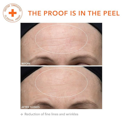 Dr. Dennis Gross Alpha Beta Ultra Gentle Daily Peel: for Dehydrated or Sensitive Skin, Uneven Tone or Texture, Fine Lines or Enlarged Pores (30 Treatments)