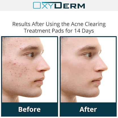 Acne Treatment Pads- Eliminates Pimple, Whitehead, blackhead, & Cystic Breakouts. Clear Clogged Pores, Oily Skin, Blemish, Dark Spots & Improve Skin Texture. 60 count