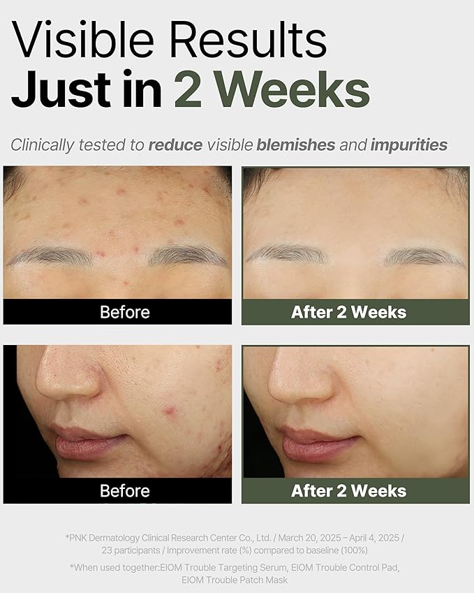 Trouble Patch Mask | Korean Face Mask ??Hydrating & Acne Face Mask for Blemish-Prone Skin, Calming Skincare & Oil Control Sheets (20ml x 4)